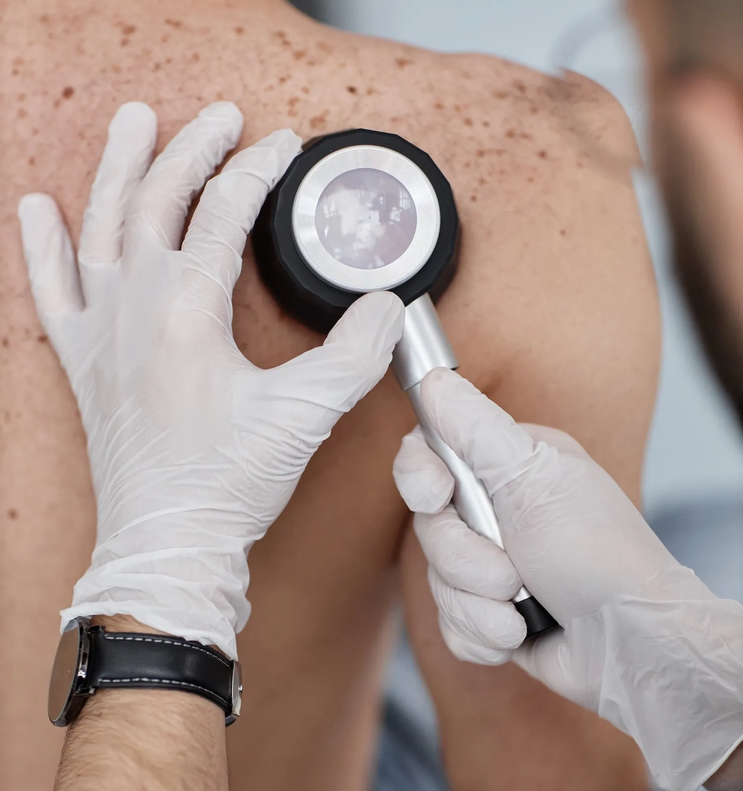 Zdravnik z dermatoskopom pregleduje znamenja na hrbtu